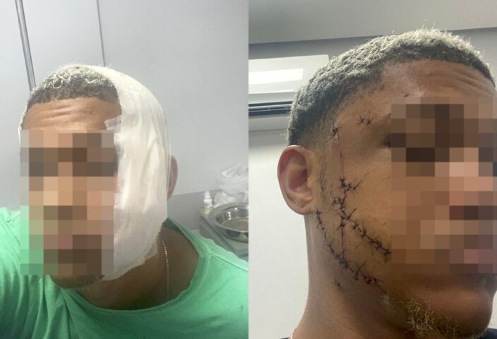 GARRAFADA NA CARA: Jovem fica desfigurado após separar briga em Stella Maris