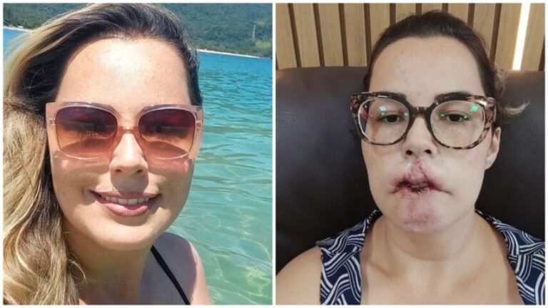 SONHO QUE VIROU PESADELO: Influenciadora que perdeu lábio após harmonização facial desabafa