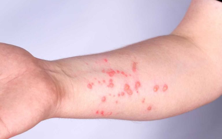 Mpox: entenda a doença declarada emergência de saúde pública global pela OMS