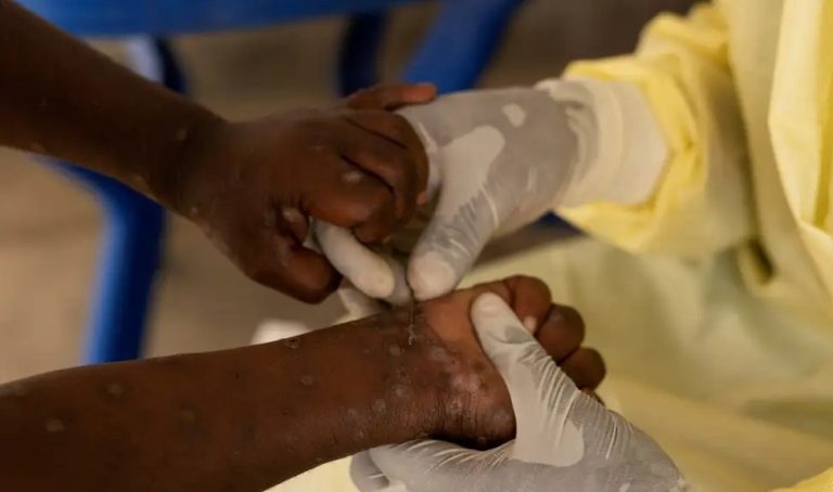 Saúde negocia compra de 25 mil doses de vacina contra mpox