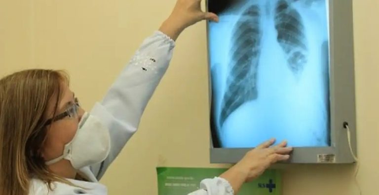 Baixo financiamento mundial ameaça combate à tuberculose