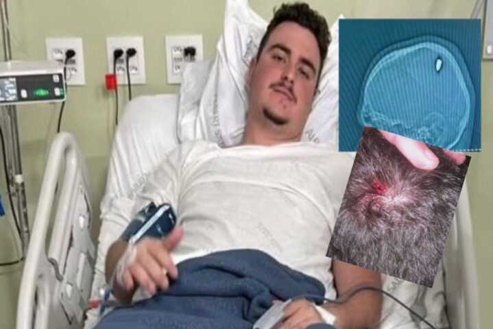 Jovem é atingido por bala perdida na cabeça e só descobre 4 dias depois: ‘Achei que fosse pedrada’