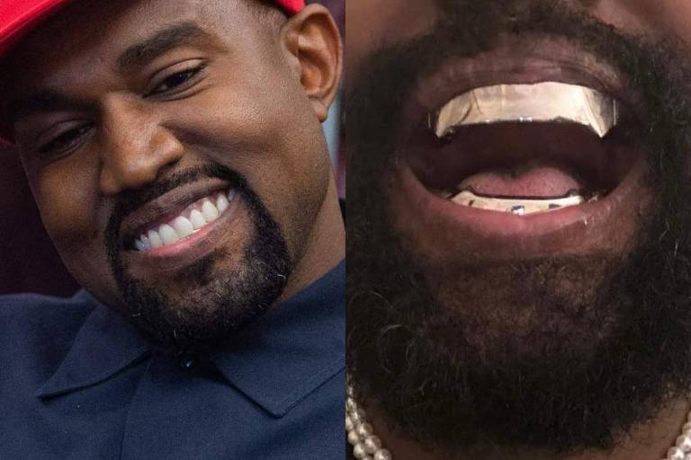 Kanye West substitui dentes por implante de titânio de R$ 4 milhões